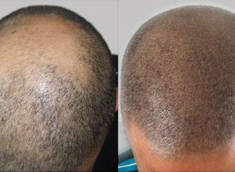 Kosmetikpraxis Saphir: Kopfhautpigmentation in Luzern Kosmetikpraxis Saphir: Kopfhautpigmentation in Luzern